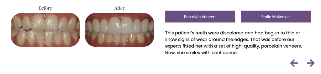 Before-and-after close-ups showing whiter, fuller teeth after receiving porcelain veneers for a smile makeover.
